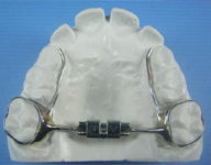 palatal expander